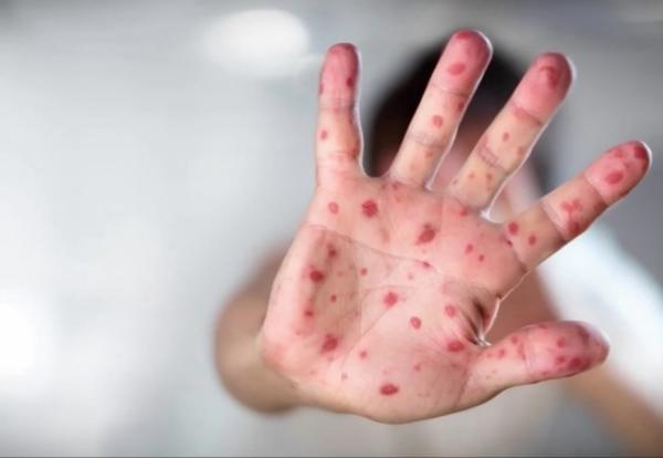 Measles Information from the Chelan-Douglas Health District